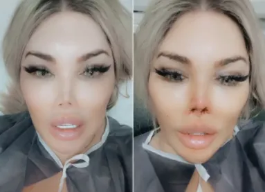 JESSICA ALVES FAZ NOVA CIRURGIA E NO NARIZ E NO QUEIXO
