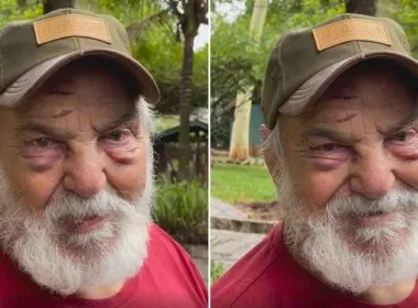 ATOR LIMA DUARTE APARECE COM ROSTO MACHUCADO APÓS LEVAR TOMBO