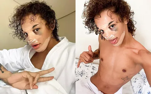 PABLLO VITTAR APARECE COM CURATIVOS APÓS CIRURGIA ESTÉTICA NO NARIZ
