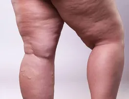 ACÚMULO ANORMAL DE GORDURA EM ÁREAS ESPECÍFICAS DO CORPO PODE SER SINTOMA DE LIPEDEMA