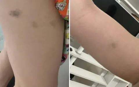 NAIARA AZEVEDO EXIBE HEMATOMAS APÓS SUPOSTA AGRESSÃO