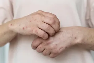 BAHIA É O 4º ESTADO COM MAIS CASOS DE MPOX NO BRASIL; 70% SÃO DE SALVADOR