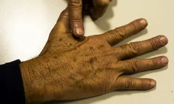 CÂNCER DE PELE GERA R$ 4,6 MI EM CUSTOS HOSPITALARES EM QUASE 2 ANOS