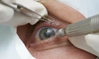 CIRURGIA QUE ALTERA COR DO OLHO TEM USO RESTRITO PARA PESSOAS CEGAS