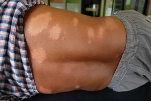 DOENÇA DE ALTA ENDEMICIDADE NA BAHIA, HANSENÍASE TEM CURA; DIAGNÓSTICO PRECOCE EVITA SEQUELAS