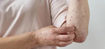 VÍRUS MPOX: BAHIA TEM DOIS CASOS CONFIRMADOS E UM DELES EM SALVADOR
