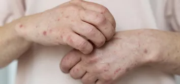 BAHIA INVESTIGA NOVO CASO SUSPEITO DE MPOX EM IRECÊ; PACIENTE ESTÁ EM ISOLAMENTO