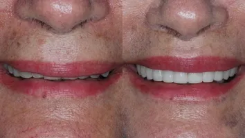 LIPLIFT SE CONSOLIDA COMO OPÇÃO PARA REJUVENESCIMENTO DOS LÁBIOS COM RESULTADO DURADOURO