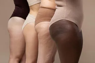 EMAGRECEU, MAS AS PERNAS CONTINUAM VOLUMOSAS? MÉDICA EXPLICA SOBRE LIPEDEMA